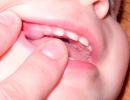 Приблизительный порядок и сроки прорезывания постоянных зубов у детей