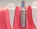 Dantų implantavimo rūšys ir procedūros aprašymas