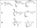 Ostrá T vlna a shodná ST elevace pouze v PVC Zvýšení segmentu st nad isolinem je známkou
