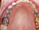 Czy ból gardła może być spowodowany problemami z zębami i dziąsłami?