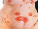 Ağız mukozasının pemfiqusunun səbəbləri və simptomları: müalicə və qarşısının alınması üsulları Ağız boşluğunda pemfiqus