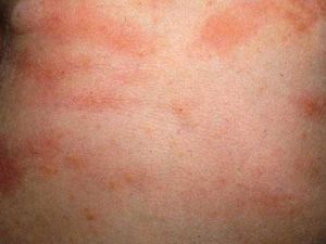 Allergiás kiütés gyermekeknél: fénykép, leírás és fajták