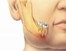 Zánět lymfatických uzlin pod zubem