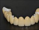 Proces instalace korunky na zub: etapy