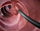 Colonoscopy of the intestine - preparation for the procedure, reviews and videos