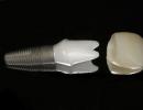 Laikini plastikiniai vainikėliai priekiniams dantims Kiek laiko vaikščioti su laikinu vainikėliu