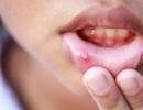 Слюнчените жлези, имунната защита на устната кухина Защита на устната лигавица осигурява