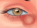 Léčba oka chalazionem Oční choroby Příznaky chalazionu