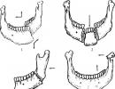 Лечение на фрактури на долната челюст