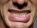 Psychosomatics และฟันคุด: สาเหตุของความเจ็บปวดและวิธีกำจัดมัน