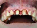 Este necesar să puneți o coroană pe un dinte: indicații și alternative Merită să puneți coroane pe dinții sănătoși?