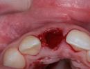 Kraujo krešulys po danties ištraukimo: ką pacientas turi žinoti
