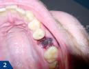 Po danties ištraukimo skauda dantenas: ką daryti