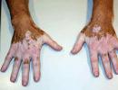 Nemoc vitiligo - Jak vyléčit vitiligo lidovými prostředky navždy Co je vitiligo a jak ho léčit