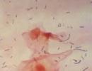 Ureaplasma a gardnerella u žen a mužů: příčiny a léčba