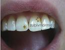 Ar madinga ant dantų montuoti rhinestones, kas tinka šiai procedūrai?
