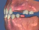 კბილების დიდი რაოდენობის არარსებობის შემთხვევაში კბილების პროთეზირება