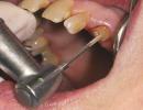 Pin in tooth - economical restoration of dentition