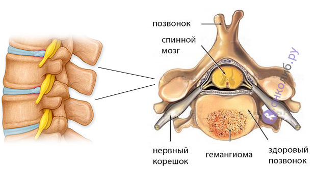 Hemangiomul coloanei vertebrale (corpuri vertebrale): cauze, semne, cum se tratează, dacă se elimină depășește 1 cm