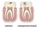 Fístula en la encía cerca del diente debajo de la corona Fístulas en la cavidad bucal
