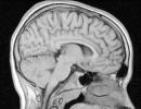 Co to jest MRI przysadki mózgowej?