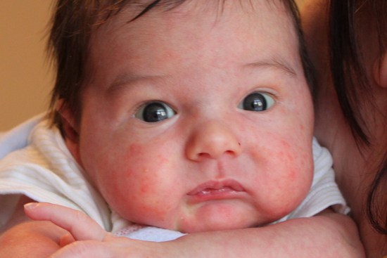 Egy kis bőrkiütés megjelenése a gyermeken a testén: okok és kezelés
