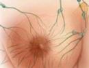 Příznaky fibrocystického onemocnění prsu a způsob léčby tohoto onemocnění