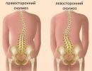 Skolióza chrbtice a ich hlavné znaky