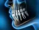 Process and stages of dental implantation