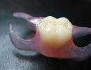 Dantų protezų tipai, klasifikacija, kainos, apžvalgos