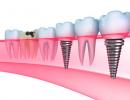 Dantų implantacijos etapų aprašymas